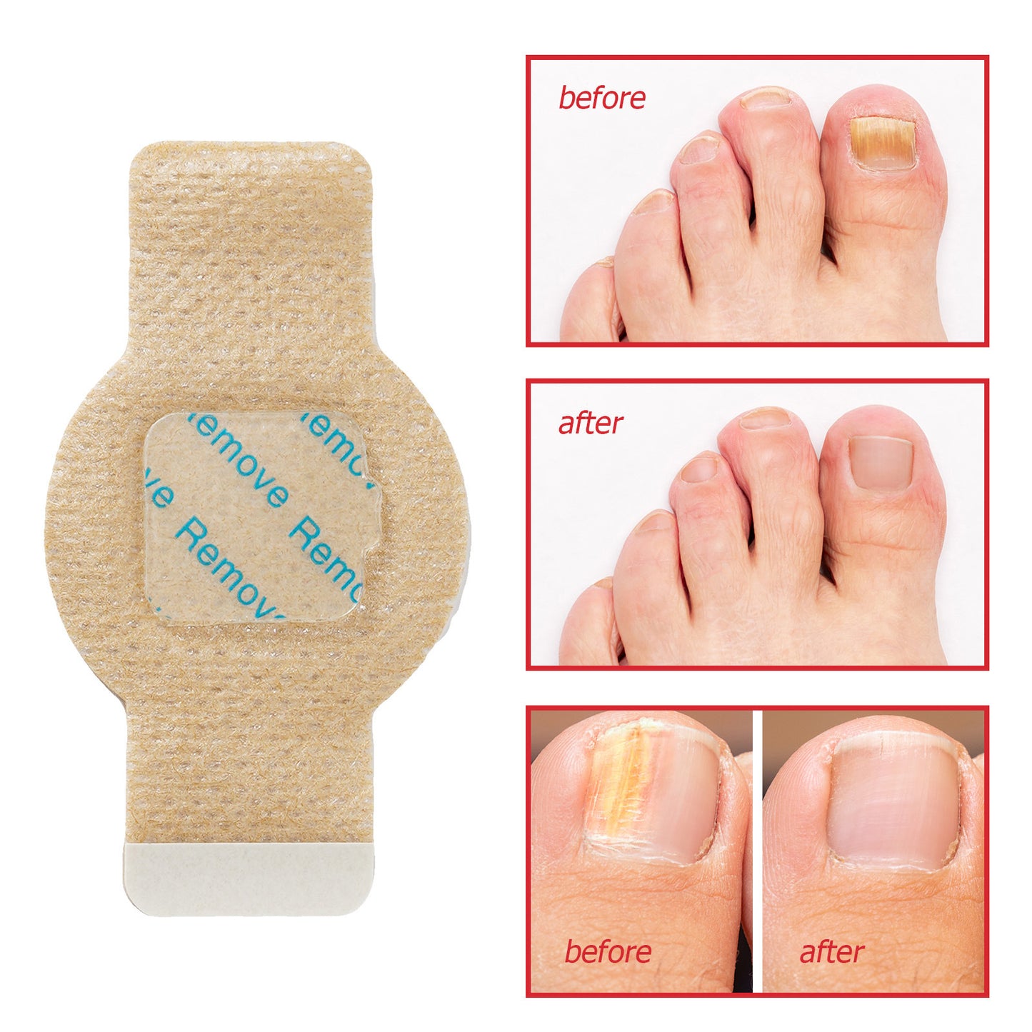 Antibacterial Nail Patch